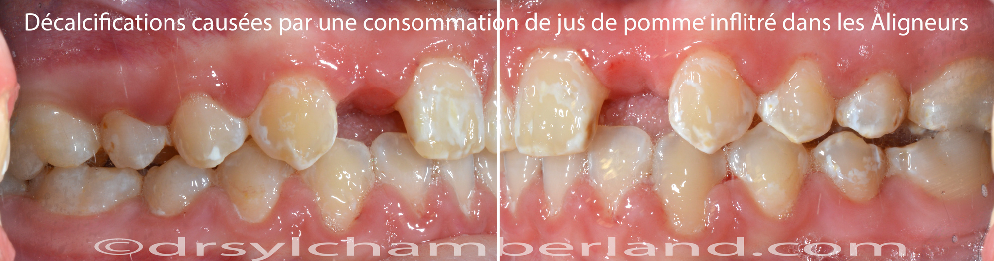 Décalcifications causées par du jus de pomme avec des aligneurs en bouche.