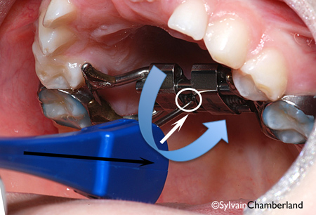 2-Comment activer l'appareil d'expansion étape 2-Dr Chamberland orthodontiste à Québec