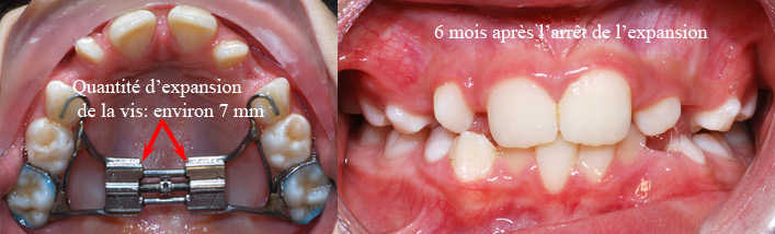 Après expansion et 6 mois plus tard-Dr Chamberland orthodontiste à Québec