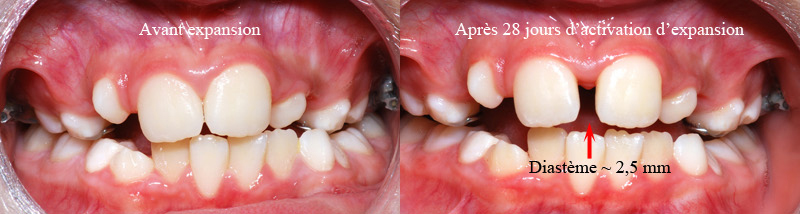 Avant et après expansion-Dr Chamberland orthodontiste à Québec