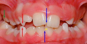 Constriction palatine glissement fonctionnel-Dr Chamberland orthodontiste à Québec