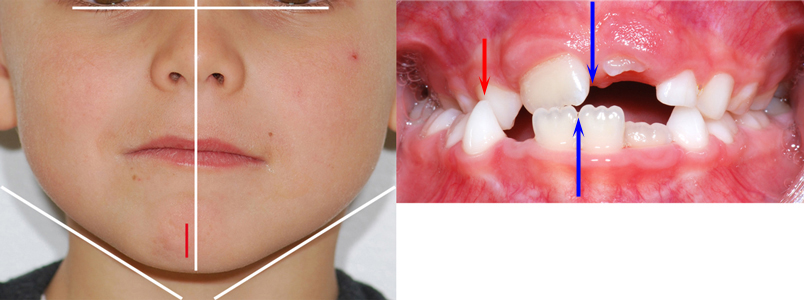 Latérodéviation mandibulaire et articulé croisé postérieur droit crossbite-Dr Chamberland orthodontiste à Québec