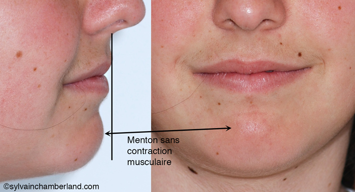 AnMACh post genioplasty face and profile-Dr Chamberland orthodontist in Quebec City