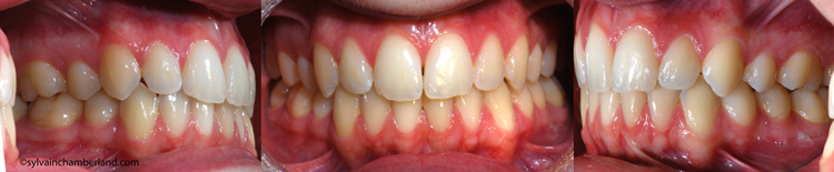 Asymétrie camouflage dentaire-Dr Chamberland orthodontiste à Québec