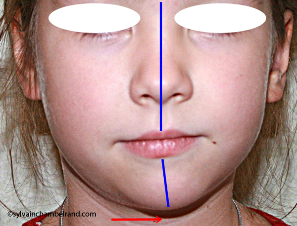 Asymetrie-faciale-gauche-Chamberland-Orthodontiste-Quebec