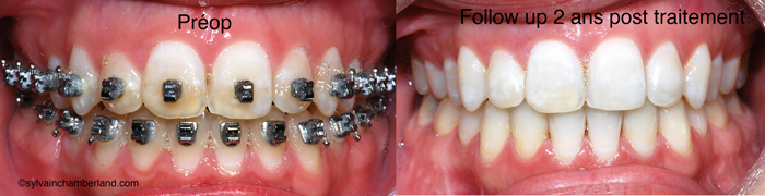 Béance antérieure MaJeBe-Dr Chamberland orthodontiste à Québec