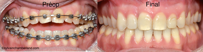 Béance antérieure PaBi-Dr Chamberland orthodontiste à Québec