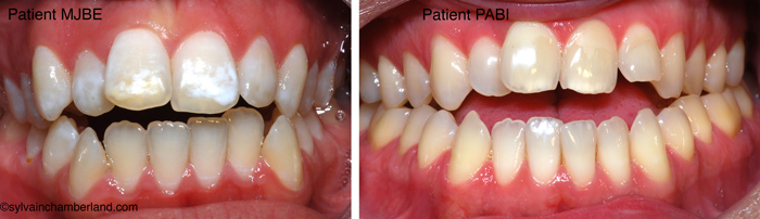 Anterior open bite PaBi and mJ Bea-Dr Chamberland orthodontist in Quebec City