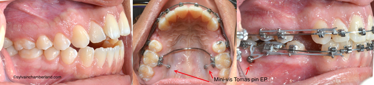 Béance antérieure minivis d'ancrage tomas pin EP LiMa Nda-Dr Chamberland orthodontiste à Québec