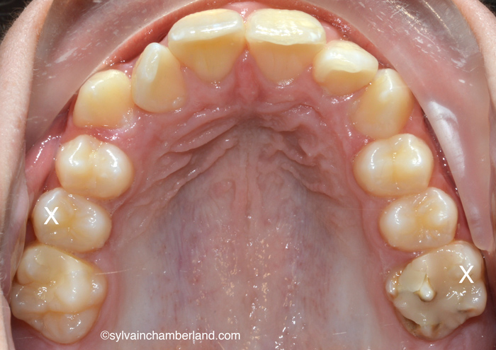 28-08-2014 Hypominéralisation de l'émail-Dr Chamberland orthodontiste à Québec