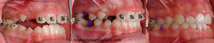 Extraction 1res molaires béance antérieure AnPiLe-Dr Chamberland orthodontiste à Québec