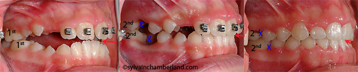 Extraction first molars anterior open bite AnPiLe-Dr Chamberland orthodontist in Quebec City