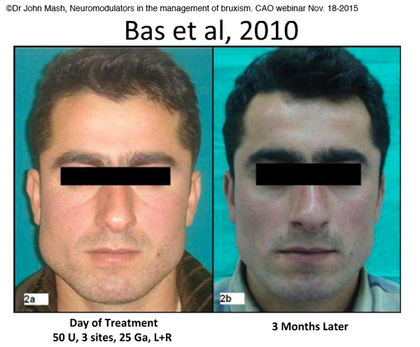 Hypertrophie du masséter et Botox-Dr Chamberland orthodontiste à Québec