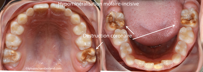Hypominéralisation molaire-incisive EtSav-Dr Chamberland orthodontiste à Québec