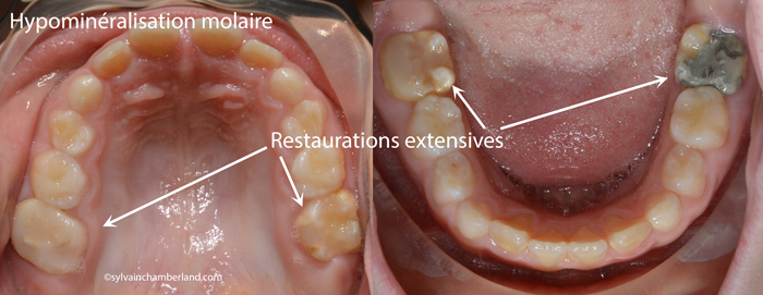 Hypominéralisation molaire-incisive MaBri-Dr Chamberland orthodontiste à Québec