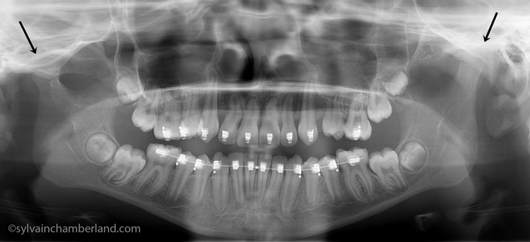 JuLe-fracture-condylienne-bilatérale-orthodontiste-Chamberland-Québec_07032013_084231