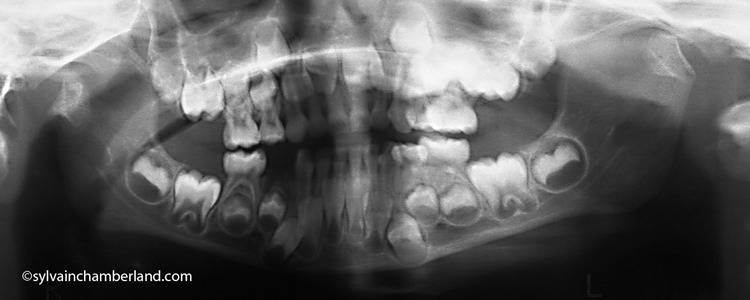 JuLe-fracture-condylienne-bilatérale-orthodontiste-Chamberland-Québec-20-10-06P