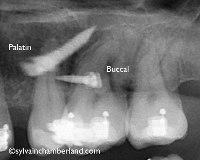 Anchorage miniscrews. The miniscrews are inserted between teeth and must not be in contact with the roots.