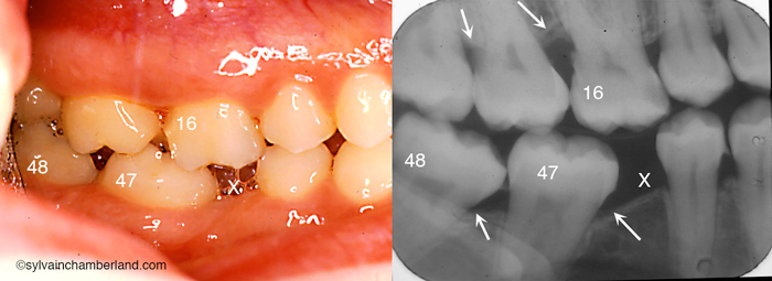 Mutilation de la dent #46 (X). Bascule mésiale des dents #47 et #48. Hyperéruption de la dent #16. Problème parodontal adjacent indiqué par les flèches.-Dr Chamberland orthodontiste à Québec