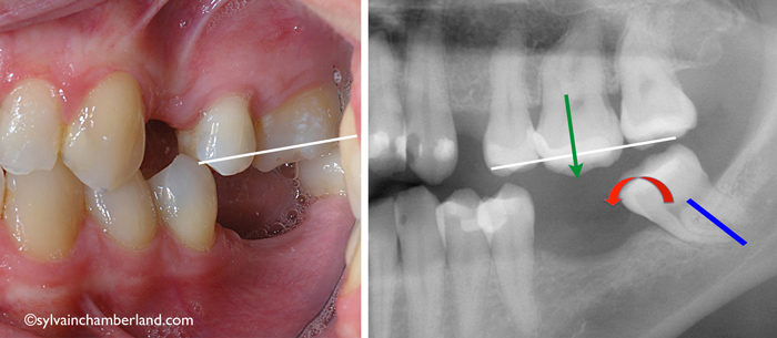Mutilation-dentaire-égression-molaire-orthodontiste-Chamberland-Québec