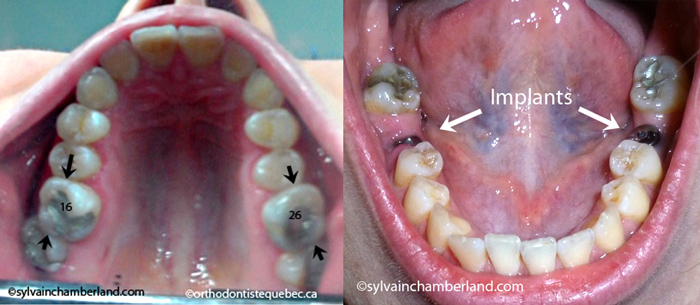 Mutilation-dentaire-et-hyperéruption_égression-antagoniste-orthodontiste-Chamberland-Québec