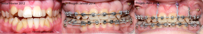 PaPl béance antérieure minivis ancrage-Dr Chamberland orthodontiste à Québec