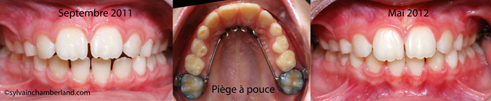Piège à langue PaCaPla-Dr Chamberland orthodontiste à Québec