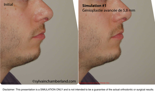 Simulation-1-advancement-genioplasty-of-6-mm-orthodontist-Chamberland-Quebec