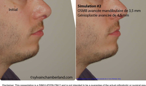 Simulation-2-OSMB-avancemenent-mandibulaire-et-génioplastie