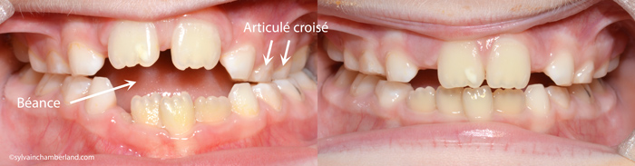 Succion-digitale-et-palais-etroit--post-expansion-MAChia-Chamberland-Orthodontiste-a-Quebec