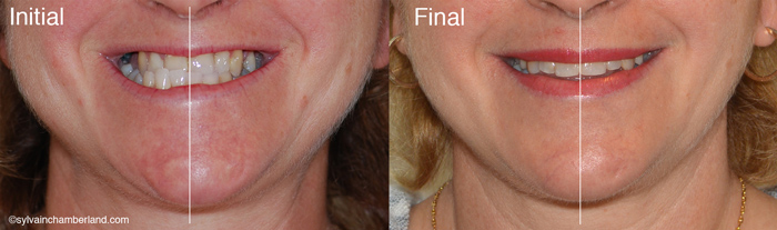 Asymétrie faciale vers la droite et classe III mandibulaire-Dr Chamberland orthodontiste à Québec